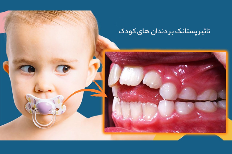 تاثیر پستانک بر دندان های کودک